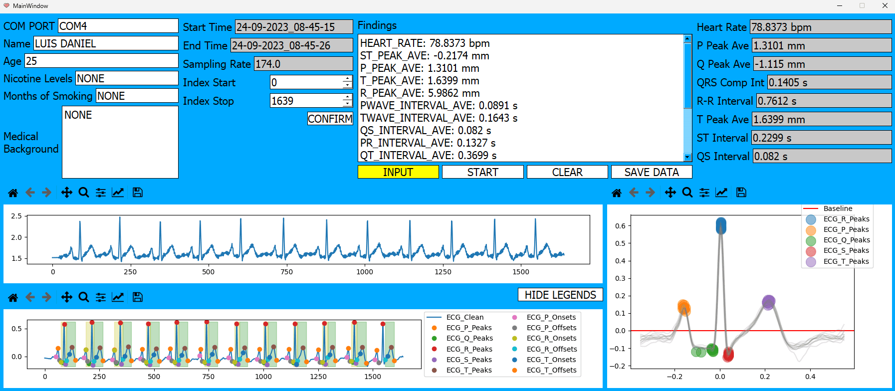 Real-Time Detection and Classification of Heart Arrhythmia using ECG Feature Detection